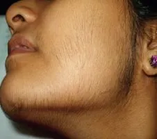 Hirsutism