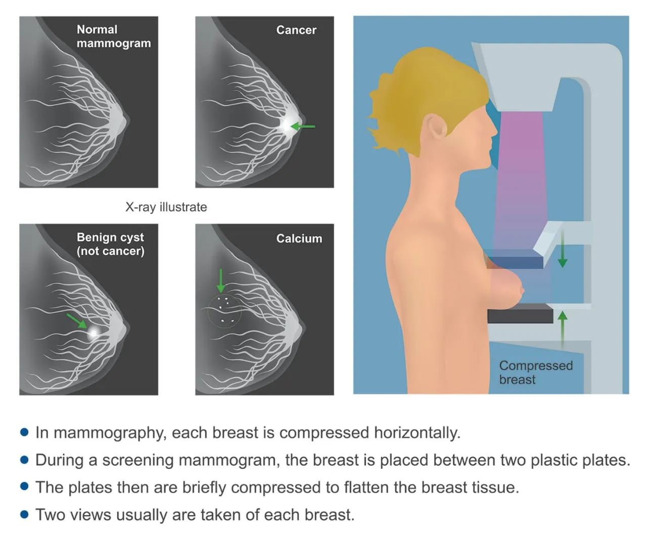 Mammography