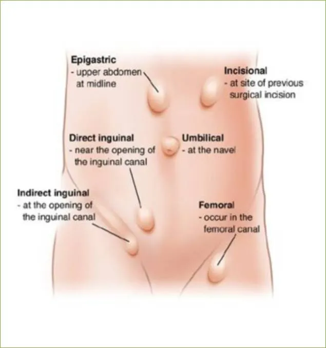 Hernia