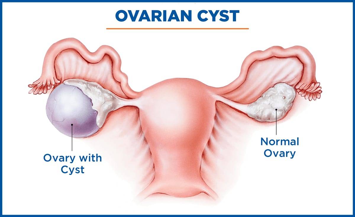 Ovarian Cyst Surgery, Ovarian Cyst Treatment in Thane, Mumbai, India