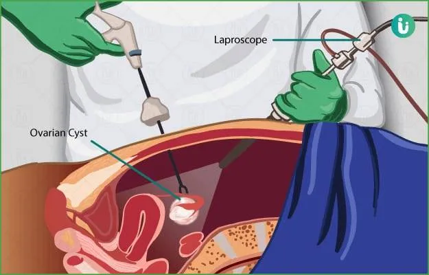 Ovarian Cystectomy
