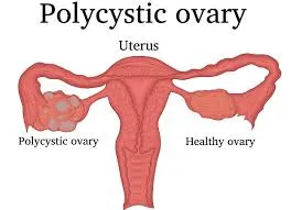 polycysticc Ovary