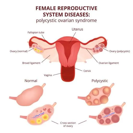 polycysticc ovarian syndrome